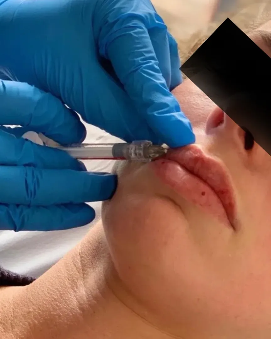 Dermal Fillers