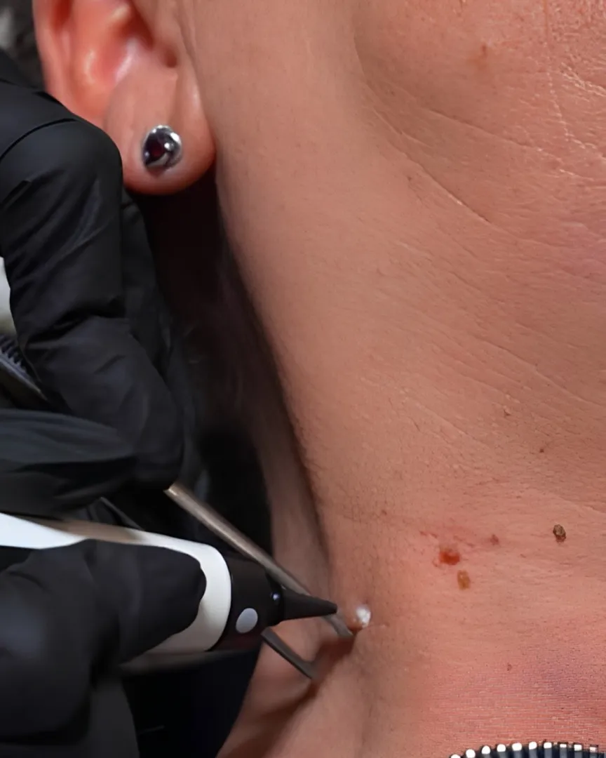 Skin Lesion Removal