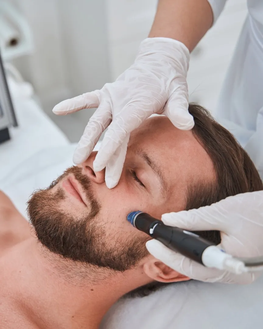 Microneedling