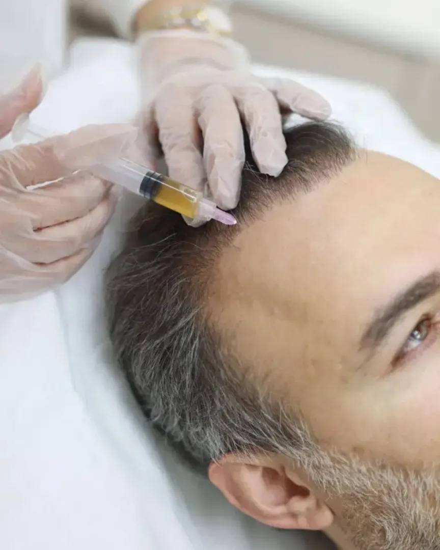 PRP (Platelet-Rich Plasma) Hair Restoration